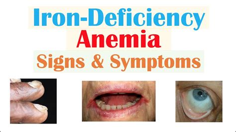 iron deficiency anemia lip discoloration|hemolytic anemia lips.